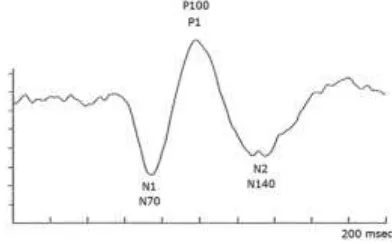 Fig. 4.  Representative normal pattern reversal VEP recorded from mid-occipital scalp using 50′ checkerboard pattern stimuli