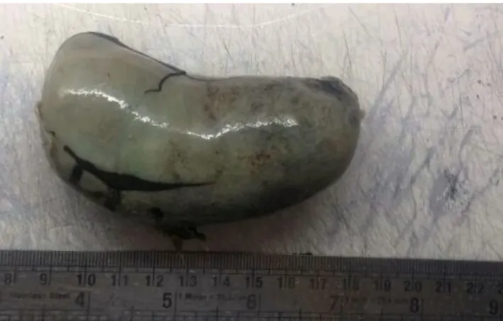 Fig. 2: Photograph showing specimen of gallbladder with gangrenous cholecystitis case, showing severely congested serosa