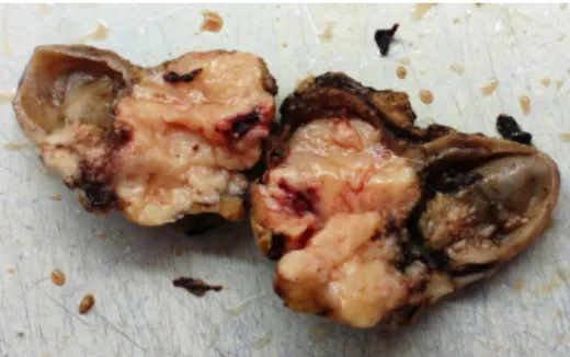Fig. 5: Photograph showing specimen of gallbladder carcinoma with growth replacing body and neck and infiltrating serosa