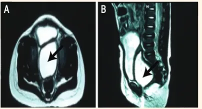 Figure 1: female showing a common channel (arrow) bifurcating anteriorly into the urinary bladder and posteriorly into the vagina
