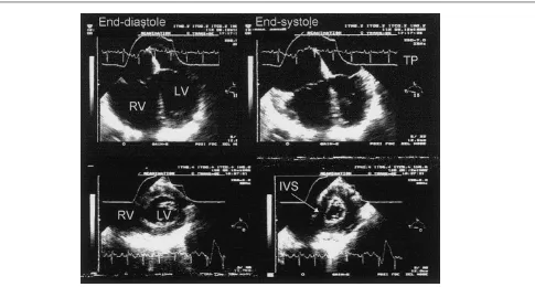 Figure 3Characteristic echocardiographic patterns of acute cor pulmonale with transesophageal echocardiography