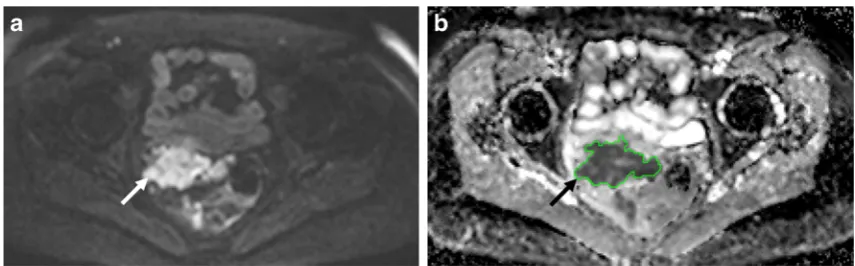 Fig. 1 Diffusion-weighted-MRI in relapsed peritoneal cancer: Axial b-value=900 mm2/s (A) and image through the mid pelvis showing anirregular mass (arrow), with restricted diffusion contoured using a semi-