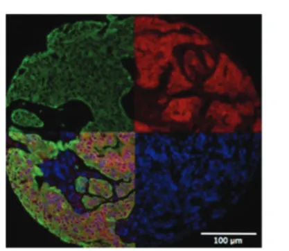 Fig. 6QuantitativeimmunoﬂuorescenceusingAQUAtoquantifytarget signal (Her2, red, top right) in cells marked for cytokeratin (i.e.tumour cells, green, top left) in MTS