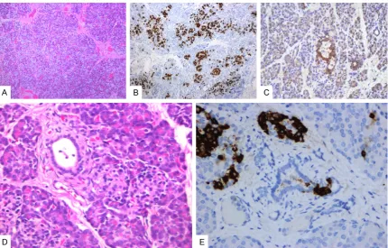 Figure 1. Pathologic features of focal type. A: HE stained sections of involved pancreas demonstrated β cells with an enlarged cytoplasm and a large Golgi region (×100)