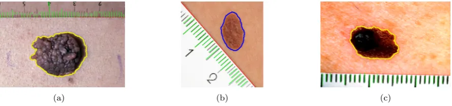 Table 2: Comparison between ruler scale detection by using manual IMAGEJ line tool and our Hough Transform(HT) method with corresponding measurements of the segmented blaze area obtained by using IMAGEJ ‘magic-wand’ (MW) tool [51], trapezium ﬁtting (Trap.) [55] (see also Figure 2) and the graph Ginzburg-Landau (GL)minimisation.
