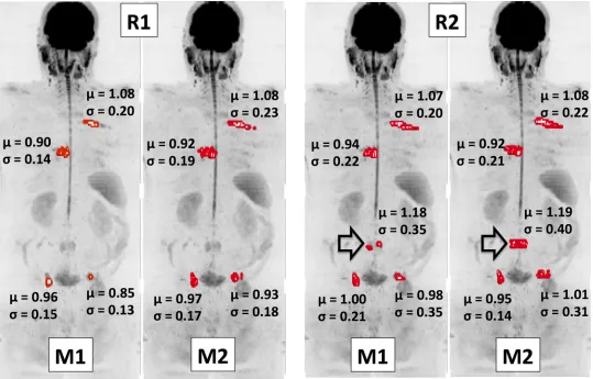 Fig 3. Coronal maximum intensity projection (MIP) of a patient diagnosed with metastatic prostate cancer (b = 900 s/mm2 images)
