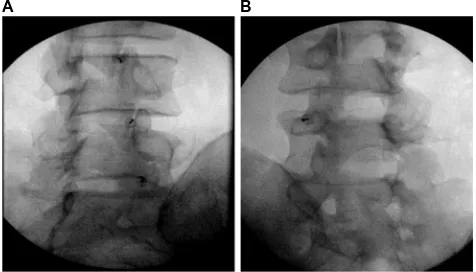 Figure 1 Sacroiliac joint injection.Notes: Characteristic lateral (A) and AP (B) intra-articular sacroiliac joint (SIJ) injection