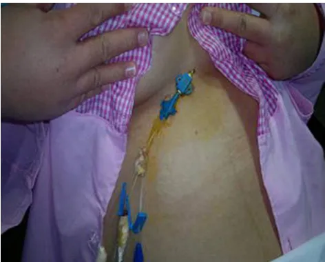 Figure 1 Central venous catheter insertion for pericardial effusion drainage via a subxiphoid approach.