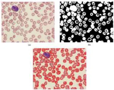 Figure 5:  (a) :Original image of Thalassemic RBS (b) Binarized image (c) Segmented   image  