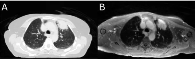 Fig. 4. (A) CT image and (B) T1-weighted MR image acquired with an ultra-fast gradient echo sequence of a NSCLC patient with a tumour located in the left upper lobe
