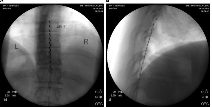 Figure 1 (A) Posterior anterior fluoroscopy image and (B) lateral fluoroscopy image of T8-T10 placement of linear leads (Nevro Corp.) for the treatment of chronic back and leg pain
