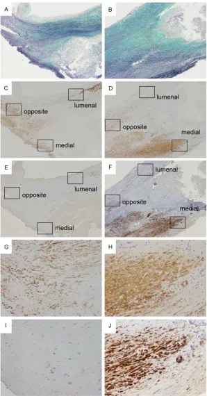 Figure 2. Elastica Masson staining (A, B) as well as Immunohistochemistry for α-SMA (C, D, G, H) and h-caldesmon (E, F, I, J) in case with postoperative cardio-vascular events (A, C, E: identical fields) and in a non-event case (B, D, F: identi-cal fields)