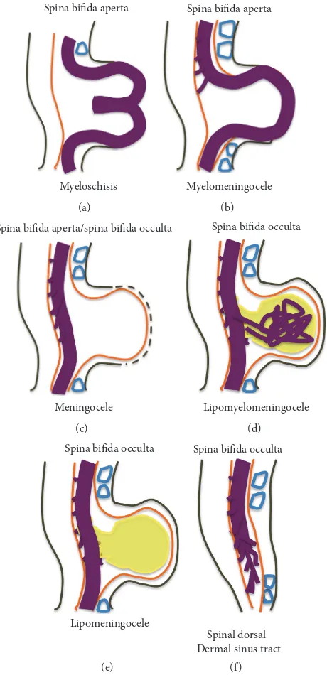 Figure 1: Schematic representation of the open (aperta) and close (occulta) types of spina bifida