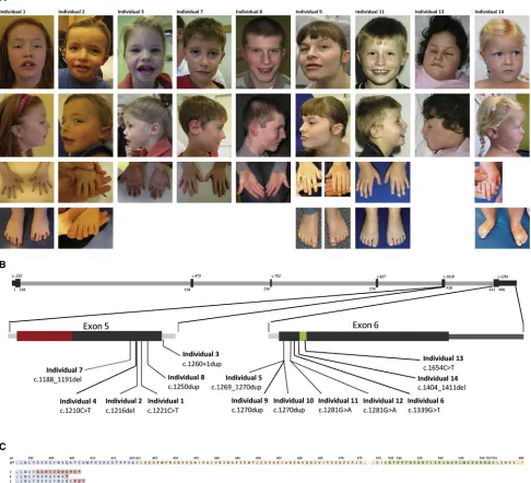 Figure 1.Photographs of Nine Individuals with a Truncating Mutation in PPM1D, De Novo Mutations in PPM1D, and PredictedConsequences at the Protein Level(A) Shared facial features including a broad forehead, upturned nose, broad mouth with thin upper lip, a