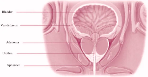 Figure 3. Prostate adenoma (front section-facing)