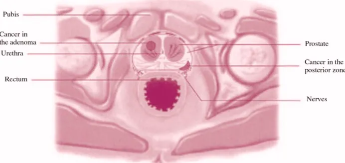 Figure 4. The prostate, adenoma and tumour (transverse-horizontal section)