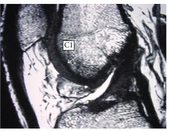 Figure 1: Mapping of MRI showing regions that are A2 and A3.White arrows show thickness in these 2 regions.