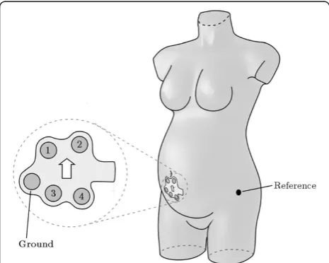 Figure 1 Schematic drawing of the patch containing fourelectrodes in a diamond shaped pattern plus a groundelectrode