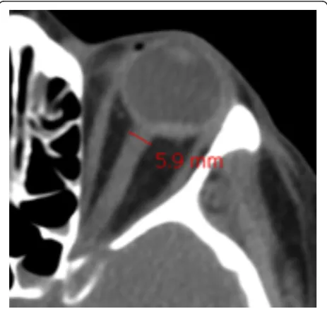 Figure 1 Optic nerve sheath diameter measurement on theinitial brain computed tomography scan (using DxMM™software).