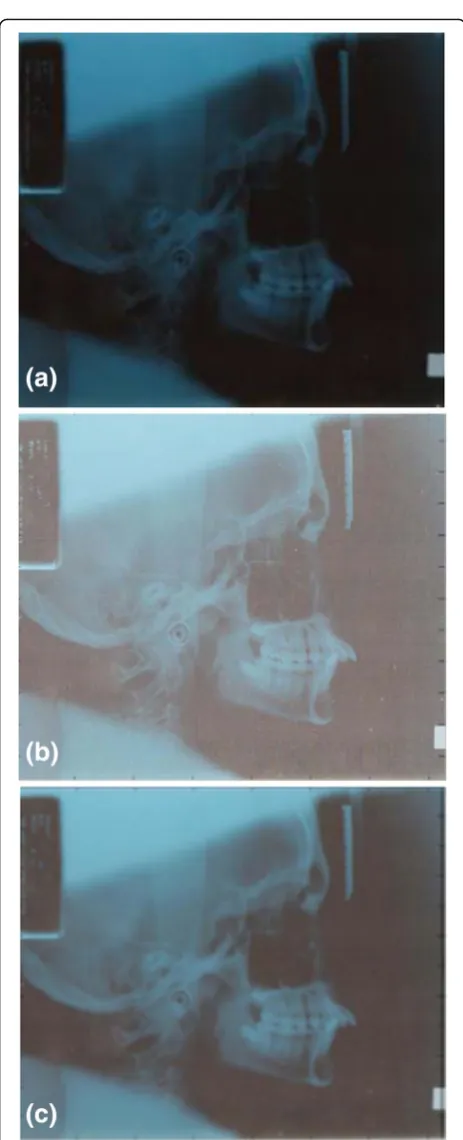 Fig. 4 Ceph-X image processing steps. (a) Original Image, (b)original image after applied Unsharp filter, (c) original image afterapplied Gaussian filter
