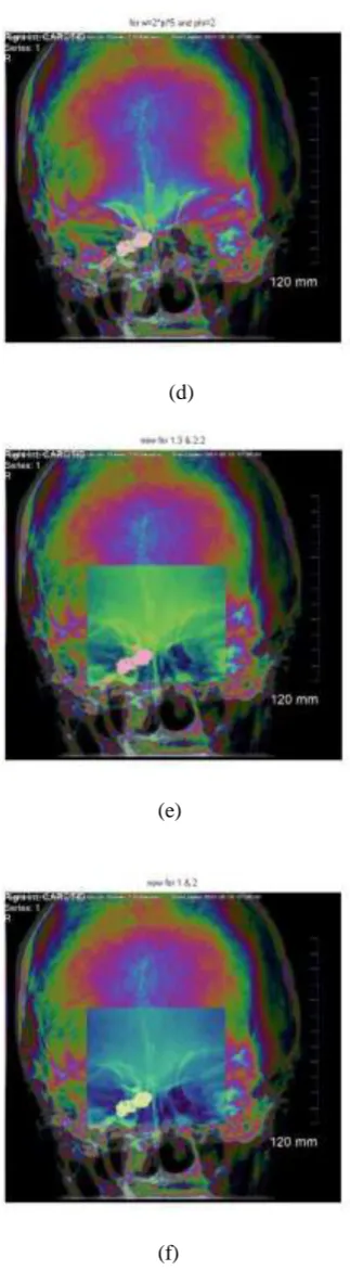 Fig. 4  MRI image of occluding coil present in the right cavernous (a) original image (b) pseudocolored with π and (c) pseudocolored with πand  (d) pseudocolored with πand ecomposite pseudocoloring selected window is pseudocolored with πand  and remaining images is pseudocolored with πand  