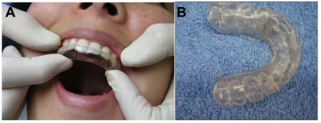 Figure 3 Maxillary stabilization splint.