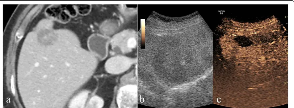 Figure 2 Liver. Contrast-enhanced CT in venous phase (a), US-B-mode (b) and CEUS (c) in a 67 year-old male patient with blunt abdominaltrauma