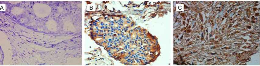 Figure 1. A. Representative β-catenin immunohistochemical staining results in a breast tumor at 400× magnifi-cation