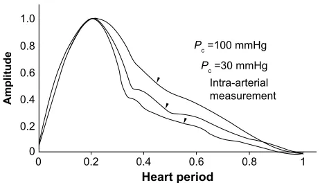Figure 1 Comparison of pressure contours obtained with the PVR and direct cannulation of the common femoral artery.Notes: Amplitude 1.0= a total of 20 mm of chart deflection