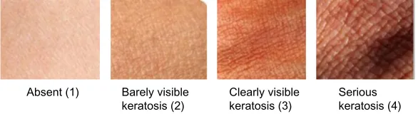 Table 1 Scale of the degree of keratosis