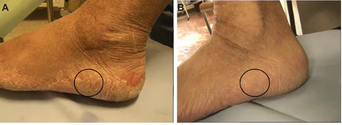 Figure 5 percentage of those who displayed improvement, subdivided in degrees of the general state of the skin at the end of the treatment period.