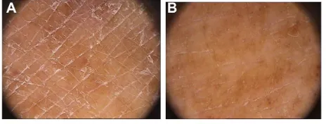 Figure 7 Macro-detail of the same case as that illustrated in Figure 6.Notes: Appearance of the skin (A) before treatment and (B) on termination of treatment with Difoprev® (LVM technologies, Bologna, Italy)