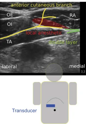 Figure 2 Anterior cutaneous branches (acb) impregnated by the dye (injection from lateral)