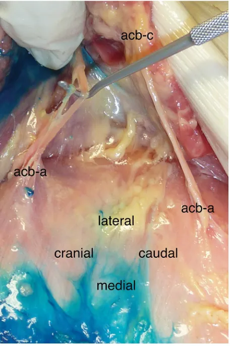 Figure 3 Lipomatous degeneration of the rectus abdominis muscle (“RA”) and restricted spread of the injectant in the cranial direction