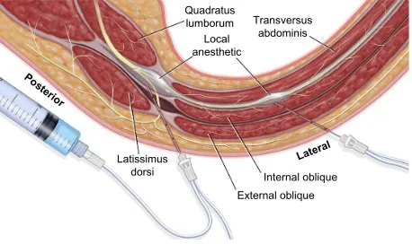 Figure 2 Surface anatomical landmarks used in transversus abdominis plane block.Note: Reproduced with permission from Webster K