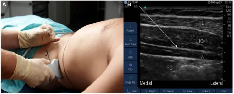 Figure 3 Ultrasound-guided lateral approach to transversus abdominis plane block.Notes: (A) is the external view and (B) is the internal ultrasound image (the arrow shows the transversus abdominis plane)