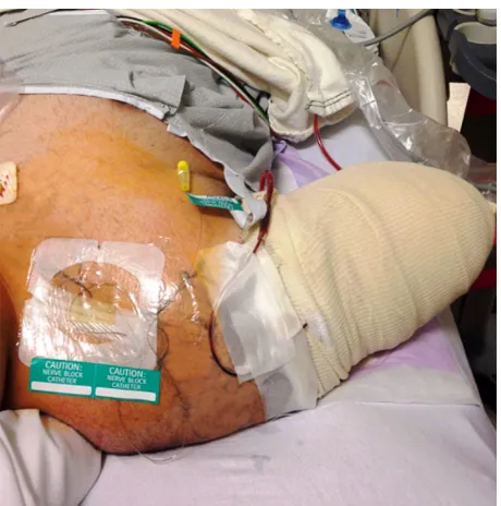 Figure 1 Patient who had suffered a traumatic amputation of the mid-humerus following a motorcycle crash.Notes: An infraclavicular catheter was placed prior to his initial surgical procedure and kept for 6 days, facilitating pain relief and multiple return trips to the operating room for debridement.