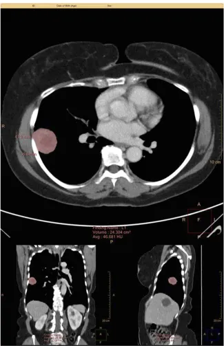 Figure 1 Example PTV measurement using the Philips Intellispace Multi-Modality Tumor Tracking (MMTT) application.