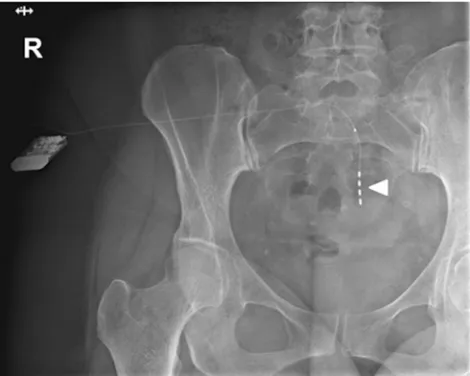 Figure 1 Anteriorpoints to the four electrodes.Abbreviaton: ﬂuoroscopy of an implanted rechargeable SNM