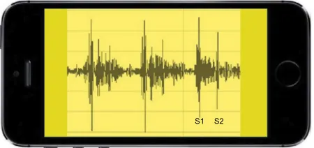Figure 6 Simulated phonocardiogram of normal S1 and S2 heart sounds seen on a portable device through Bluetooth® integration.Note: S1 and S2 represent the first and the second heart sound respectively.