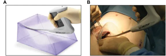 Figure 1 (an IPOM hernia repair and (Absorbable Strap Fixation Device in a porcine simulated ventral hernia model.Abbreviation: A) Illustration of the use of Ethicon Securestrap® Open Absorbable Strap Fixation Device to secure Ethicon Physiomesh™ Open Flexible Composite Mesh for B) intraoperative image obtained during fixation of Ethicon Physiomesh Open Flexible Composite Mesh using the Ethicon Securestrap Open IPOM, intraperitoneal onlay mesh.
