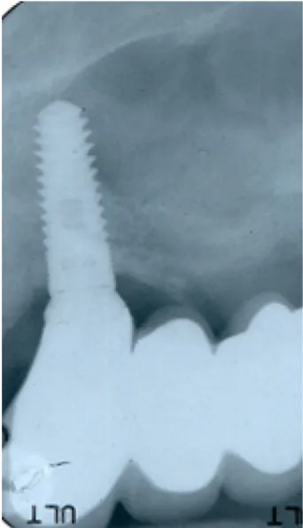 Figure 1 A 3.7×10 mm implant was placed and found to be inadequate to resist the patient’s extreme occlusal load of 1,200N.