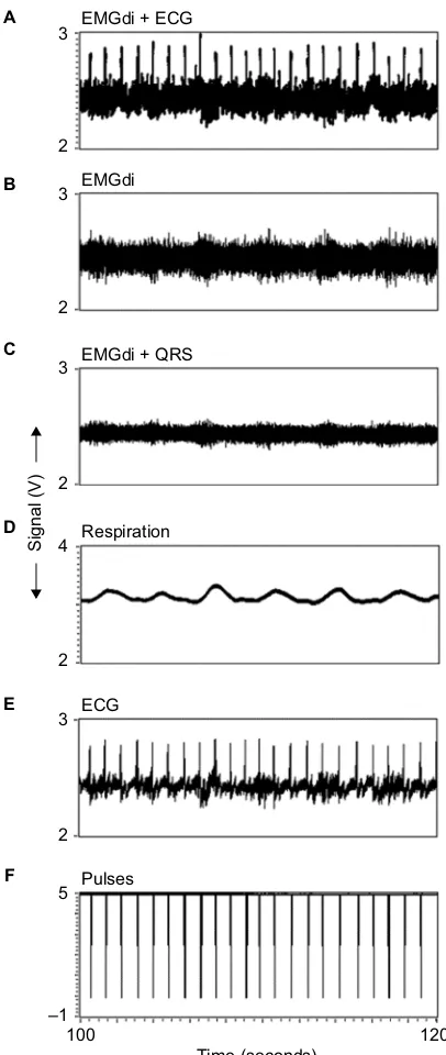 Figure 4 Signals obtained from an adult patient in a 20-second period.for the elimination of the QRS complex from the EMGdi (Figure 1 (d)–(f)).Abbreviations:Notes: (A) Signal obtained by the electrodes after the preamplification stage (Figure 1 (a) and (b)); (B) EMGdi after the removal of the whole ECG signal, including the QRS complexes (Figure  1 (h) and (i)); (C) EMGdi after the ECG elimination filter (Figure 1 (g)); (D) respiratory signal obtained from the EMGdi and its processing (Figure 1 (j) and (k)); (E) ECG signal extracted from the EMGdi (Figure 1 (a)); and (F) pulse signal used  ECG, electrocardiography; EMGdi, electromyography signal of the diaphragm muscle.