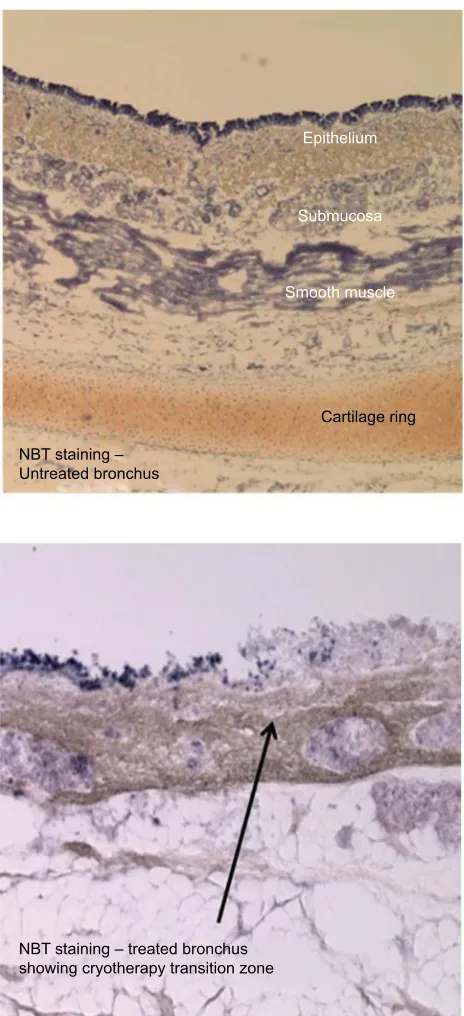 Figure 16 correspond to lethal isotherms (−20°C) in tissue 