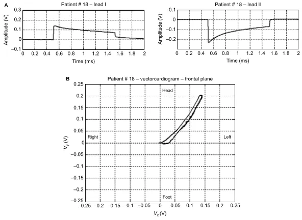 Figure 4 An example of a bipolar pacemaker waveform recorded from ECG lead I.Abbreviation: ECG, electrocardiography.