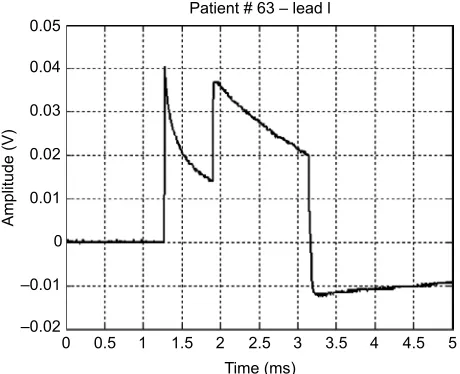 Figure 5 Waveform of a monopolar pacemaker with a defective output circuit.Note: The image shows the abrupt disruption of the proper exponential decay signal.