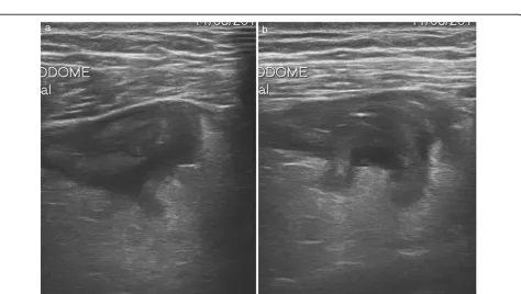Figure 2 Sonographic features of uncomplicated diverticulitis: diverticula appear as bright “ear” out of the bowel wall (a); a central shadowingechogenicity may indicate the presence of fecalith (b).