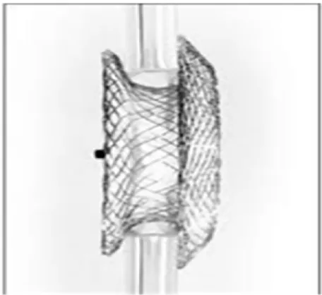 Figure 7 Figulla Occlutech septal occluder (Occlutech GmbH, Jena, Germany).