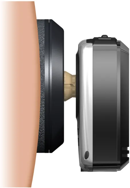 Figure 4 Baha® Attract, a passive transcutaneous skin-drive bone-conduction device.Note: image provided courtesy of Cochlear Bone Anchored Solutions AB.