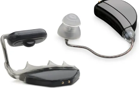 Figure 8 SoundBite™, an in-the-mouth bone-conduction device with implant for tooth attachment and behind-the-ear sound processor.Note: image provided courtesy of Sonitus Medical.